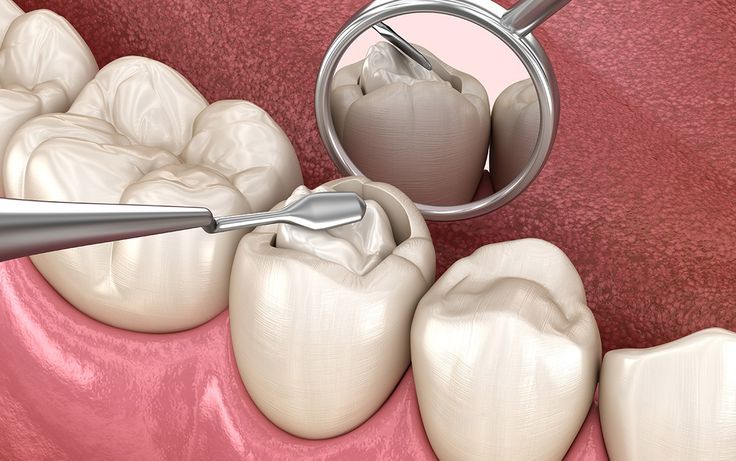 Dental filling treatment at Gold's Dental Clinic in Kalapatti, Coimbatore