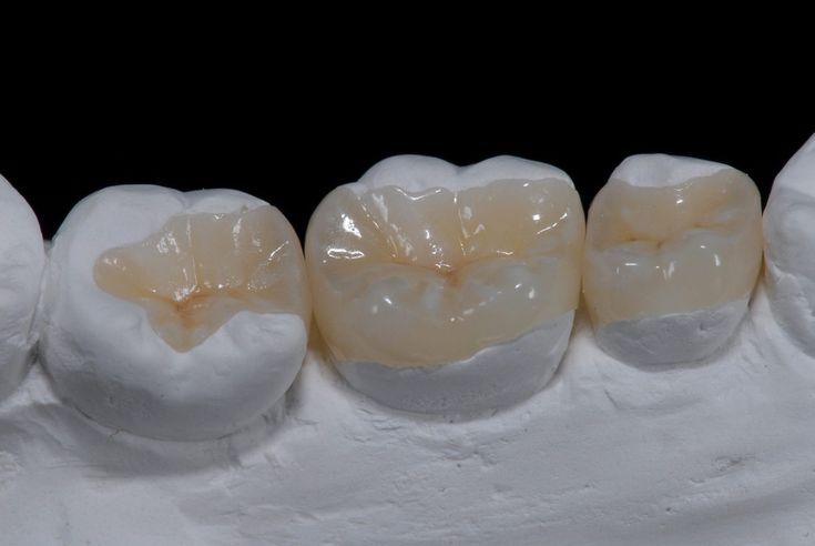 Inlays and onlays treatment at Gold's Dental Clinic in Kalapatti, Coimbatore