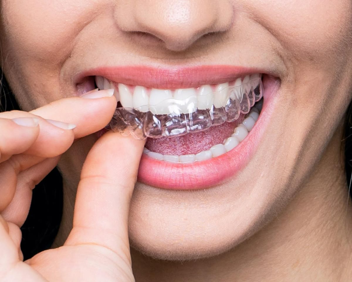 Close-up of a patient applying a clear Invisalign aligner to their teeth at Gold's Dental Clinic