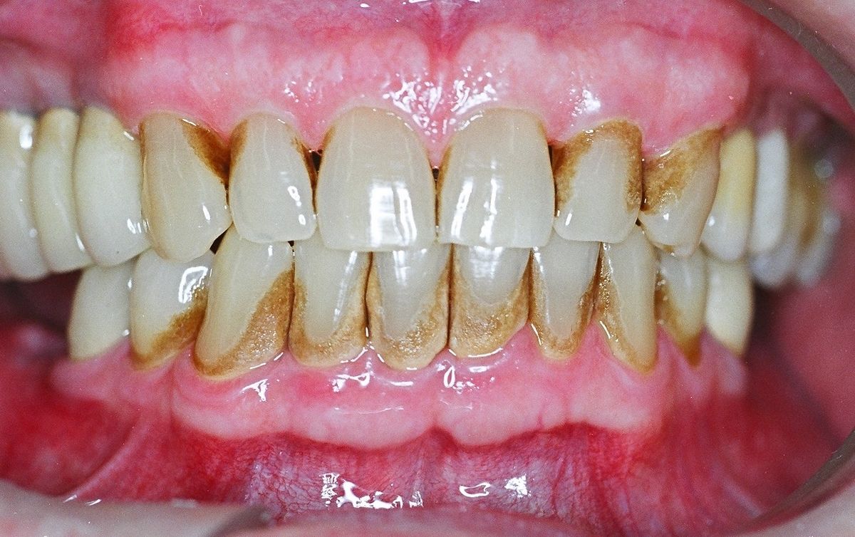 Close-up of gums and tartar buildup showing periodontal disease for gum treatment at Gold's Dental Clinic