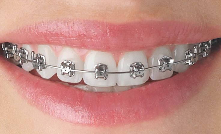 Close-up of teeth with metal braces for orthodontic treatment at Gold's Dental Clinic