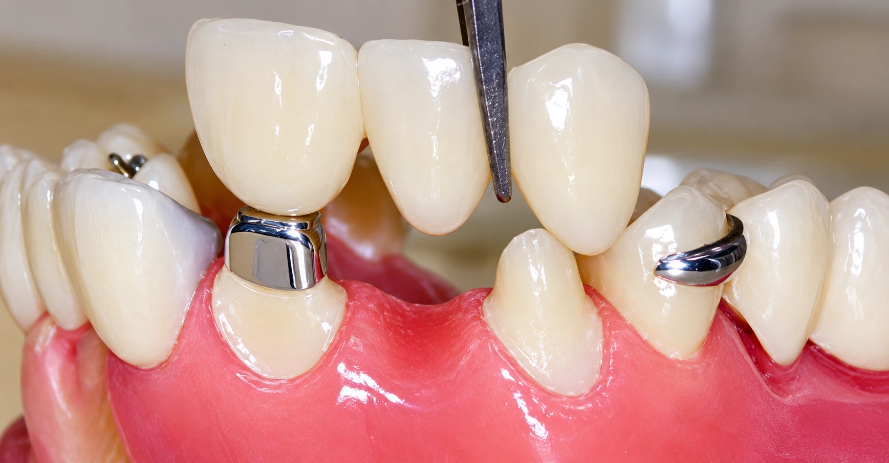 Dentures consultation at Gold's Dental Clinic in Kalapatti, Coimbatore