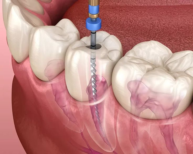 Root canal treatment illustration showing endodontic cleaning of a tooth at Gold's Dental Clinic