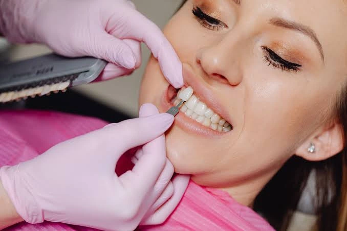 Dental veneers treatment at Gold's Dental Clinic in Kalapatti, Coimbatore